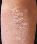 Psoriasis Le Psoriasis :