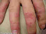 L%E2%80%99Ecz%C3%A9ma de Contact Le Psoriasis :