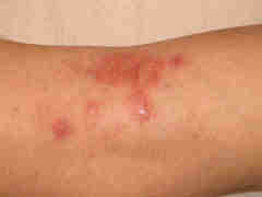 Eczema atopique Le Psoriasis :