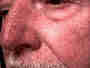 Couperose Le Psoriasis :