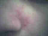 La Dermite S%C3%A9borrh%C3%A9ique Le Psoriasis :