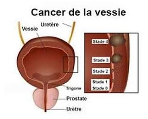 Cancer De La Vessie Savoir Fr