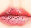 Comment éliminer les gerçures des lèvres ?