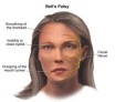 Atteintes du nerf facial:Infection et paralysie faciale