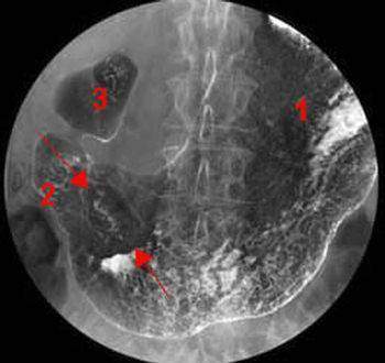 Cancer de l'estomac et du duodénum