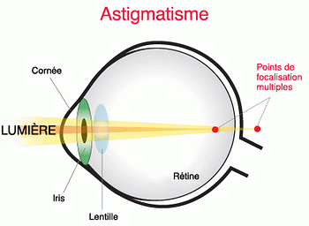 Signe cancer Fatigue