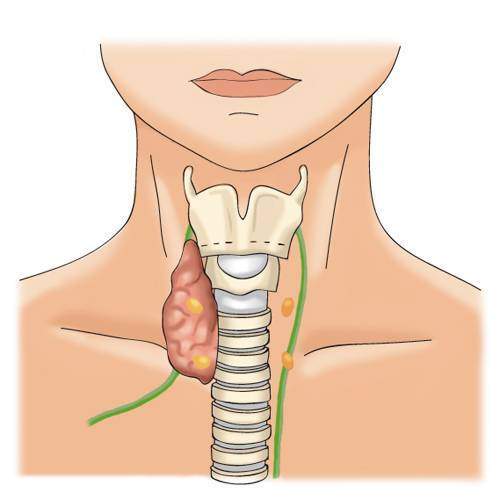 Douleur thyroide