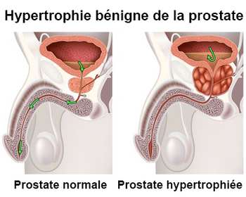 Adenome prostate