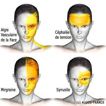 Algies vasculaires de la face