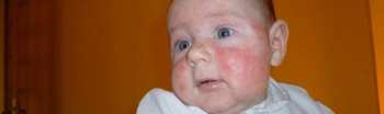 Allergie lait de vache