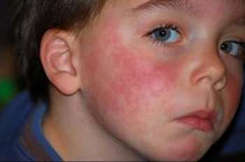 Allergie paraben