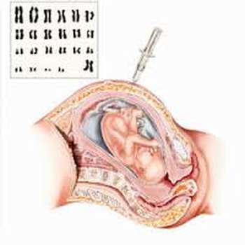 Amniocentèse