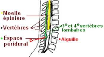 Anesthesie peridurale