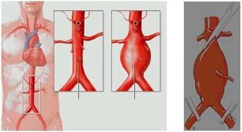 Anévrisme aorte