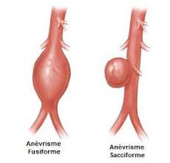 Anévrismes