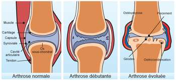 Arthrose et cartilage
