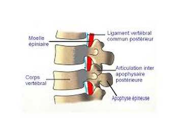 Arthrose inter apophysaire