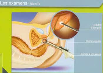 Biopsie prostate
