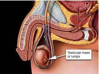 Cancer des testicule