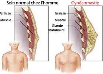 Cancer du sein chez l homme