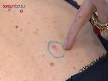 Cancer peau