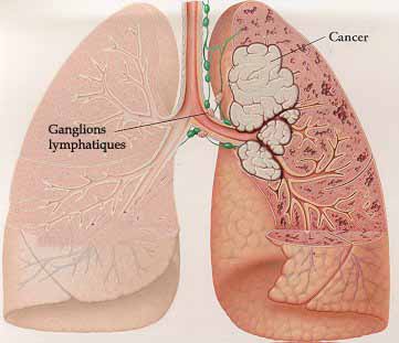 Symptômes cancer poumons