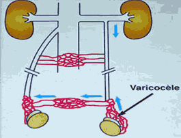 La varicocèle
