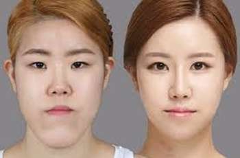 Chirurgie plastique