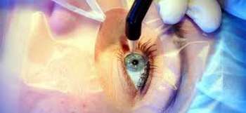 Chirurgie refractive