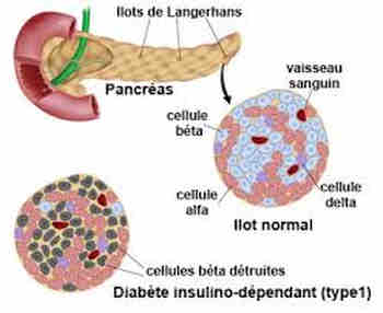 Diabète insulinodépendant