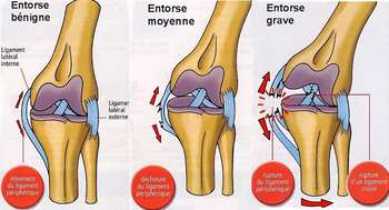 Entorses genou