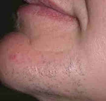 Epilation définitive