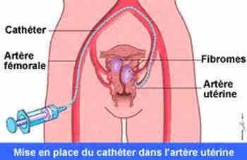 Fausse couche