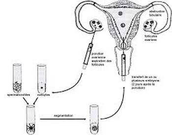 Fécondation in vitro