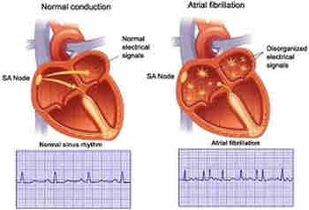 Fibrillation auriculaire