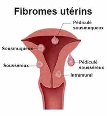 Fibrome et grossesse