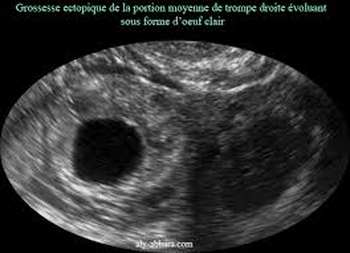 Grossesse extra uterine