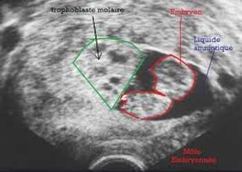 Grossesse molaire