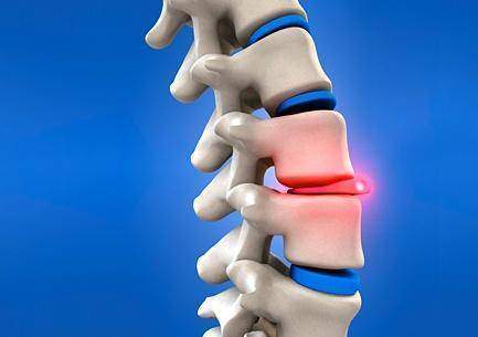 Hernie discal