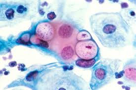 Infection à chlamydia