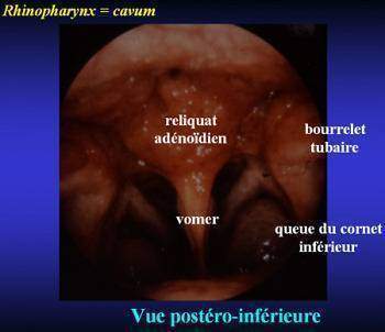 Le cancer du cavum : Traitement