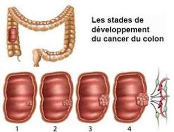 Cancer des intestins