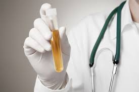 Lithiase urinaire