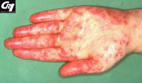 Lupus maladie