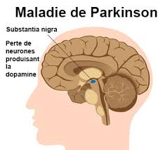 Maladie de Parkinson