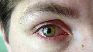 Maladie des yeux