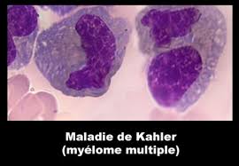 Maladie kahler