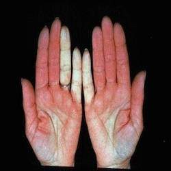 Maladie raynaud