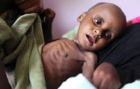 Malnutrition
