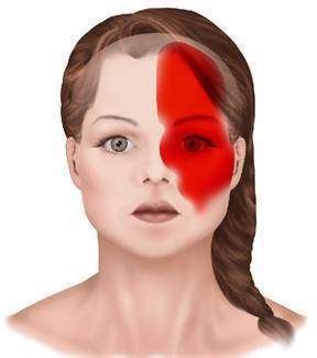 Migraine headaches